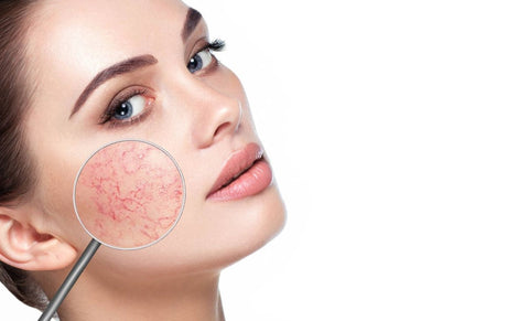 ¡No te rindas a la cuperosis!